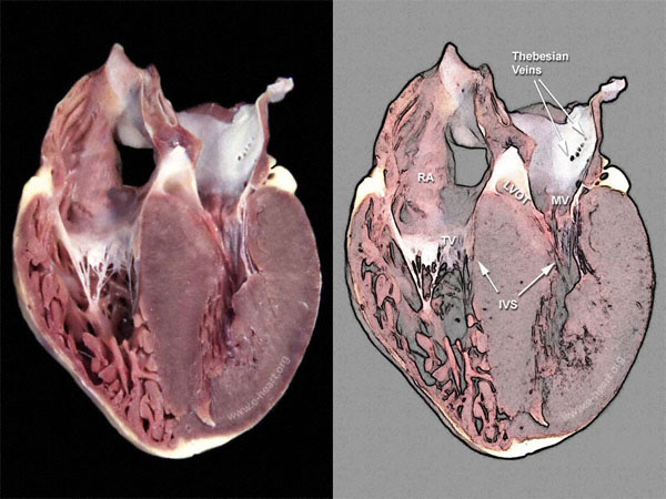 Hypertrophic Cardiomyopathy - HCM