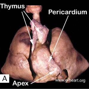 Heart in Mediastinum 1