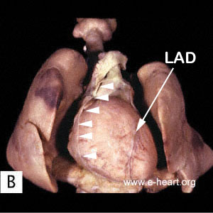 Heart in Medistinum 2