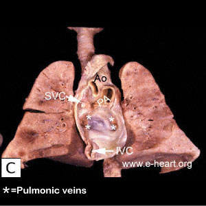 Heart in Mediastinum 3