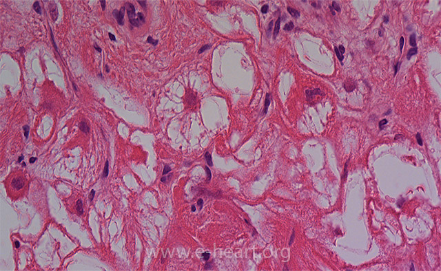 Рабдомиома сердца. Рабдомиома патанатомия. Рабдомиома сердца гистология. Рабдомиома миокарда патанатомия. Рабдомиома сердца микропрепарат.