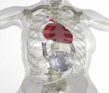 HearMate I in Thorax